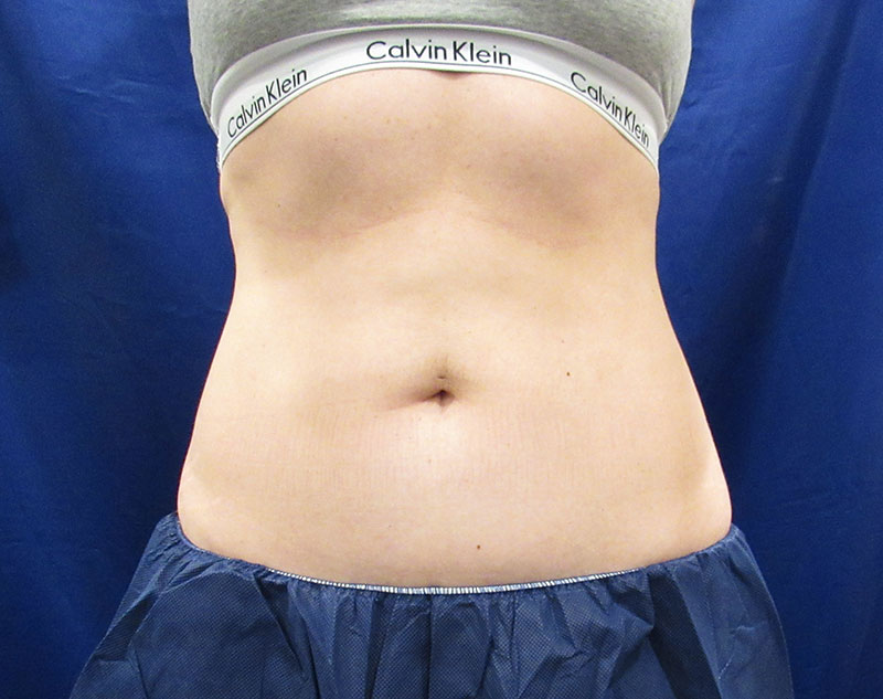 frontal photo of coolsculpting 