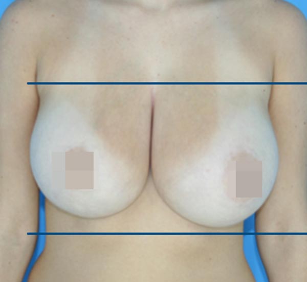 BodyTite Breast before
