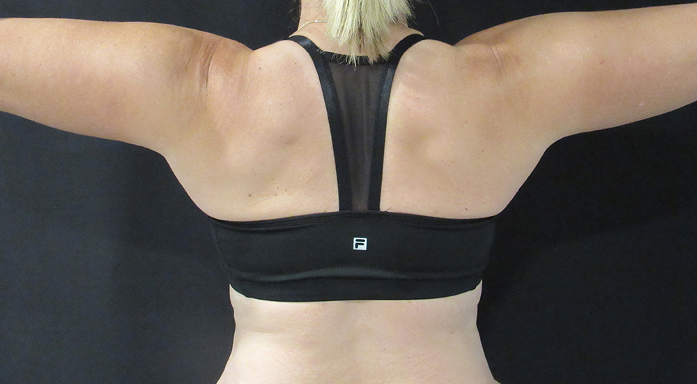 back view of arms after coolsculpting
